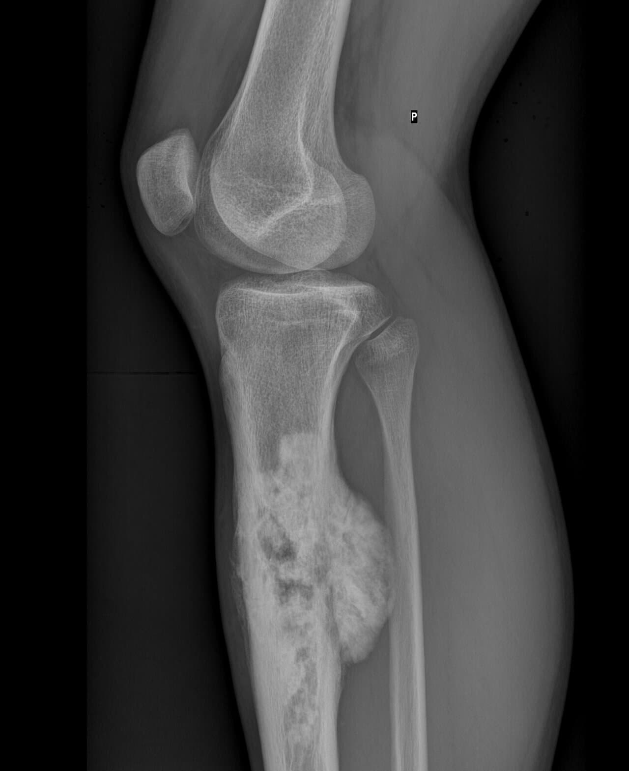 Lateral knee radiograph showing osteosarcoma of the proximal tibia