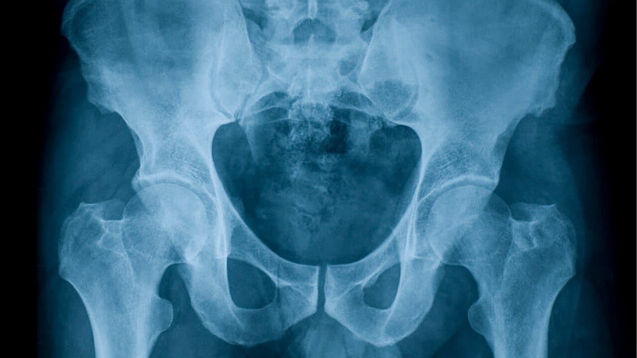AP pelvis X-ray showing both hip joints