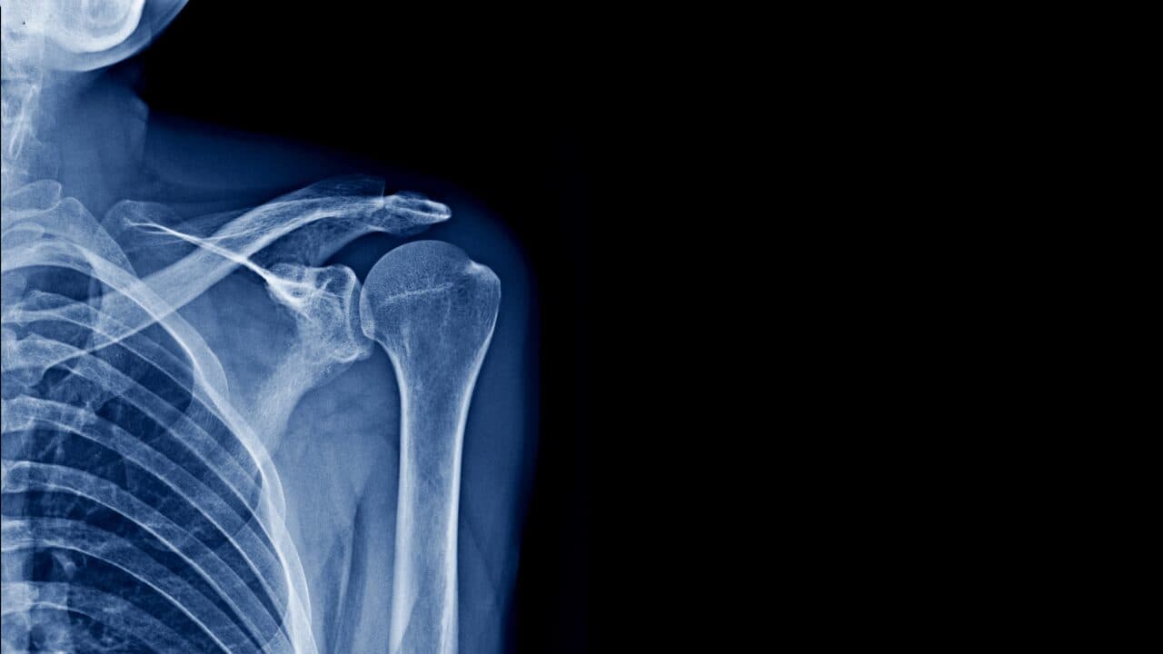 Lateral shoulder X-ray