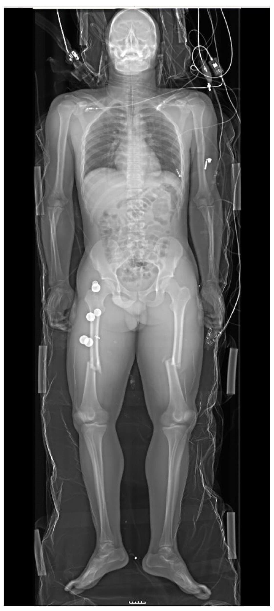 Whole-body trauma radiograph showing bilateral femur fractures