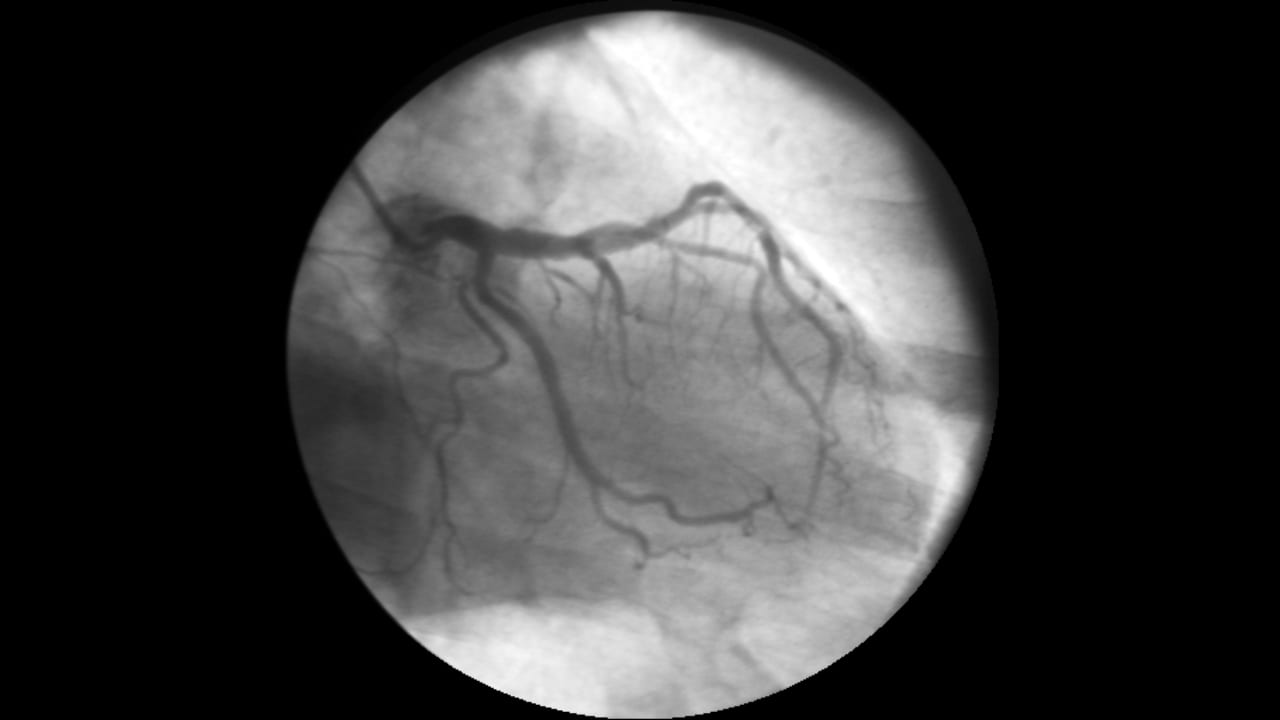 Coronary angiogram showing the left coronary artery and its branches