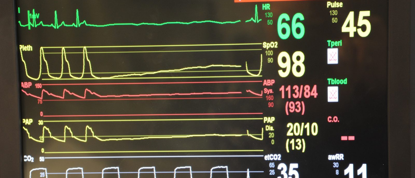 A patient monitor displaying ECG and pulse oximetry waveforms with heart rate and oxygen saturation readings.