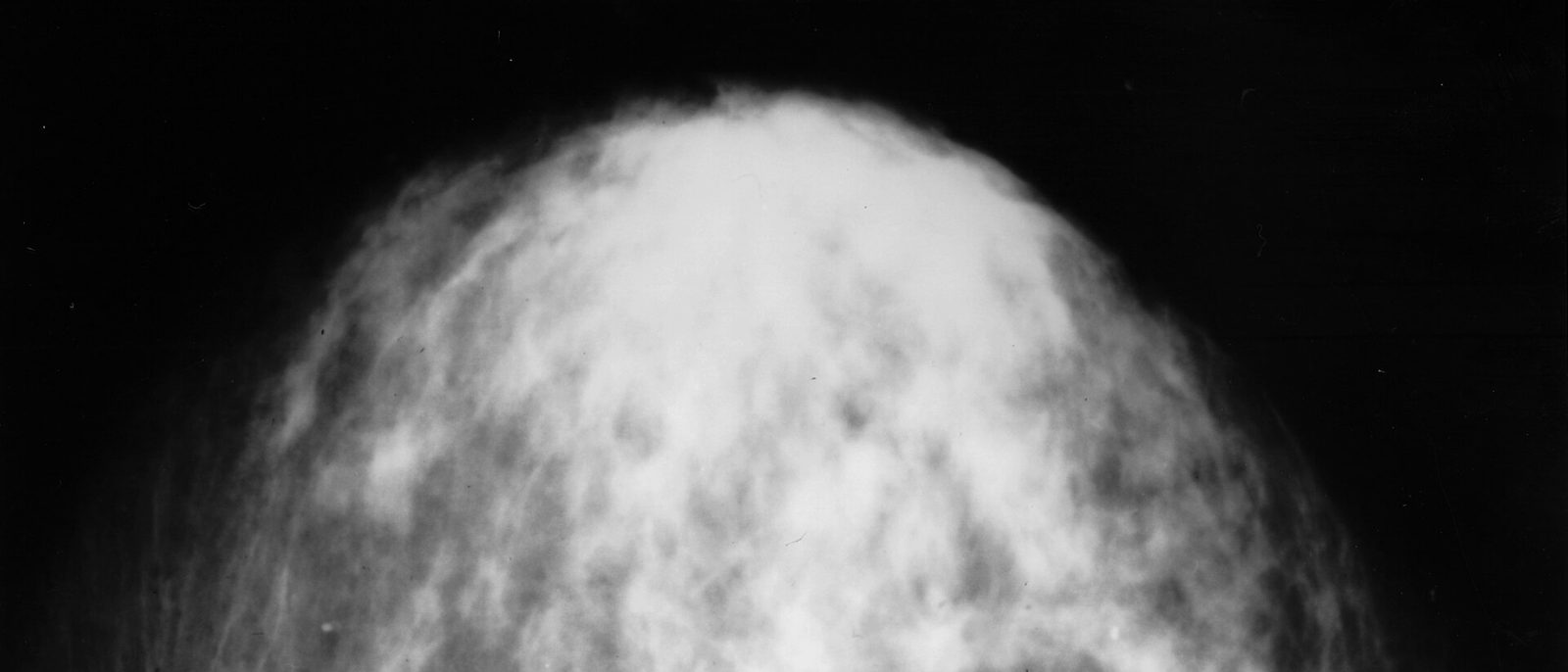 Mammogram X-ray of a breast, showing dense white glandular tissue within the rounded outline of the breast.