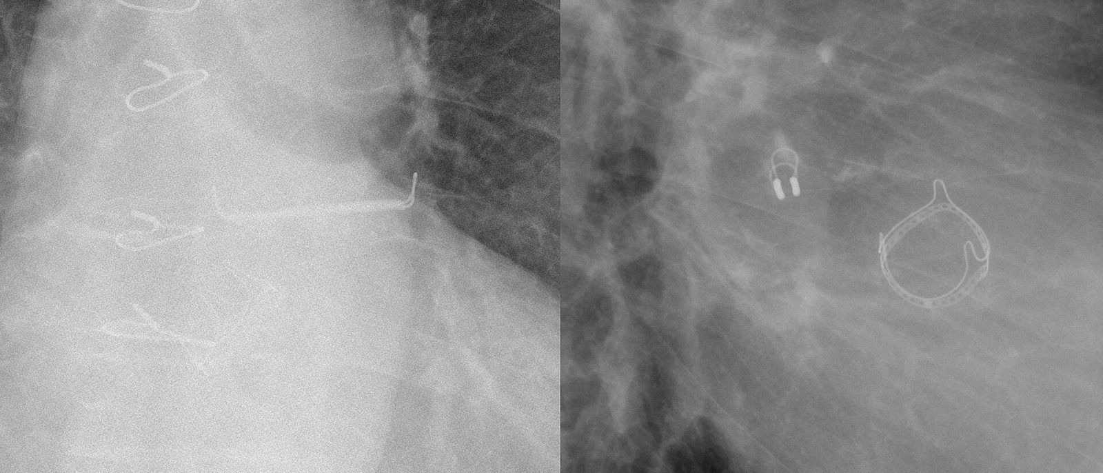 Chest X-ray detail after open-heart surgery showing a column of twisted sternal wires and, on the side view, the metal ring of a replacement heart valve.