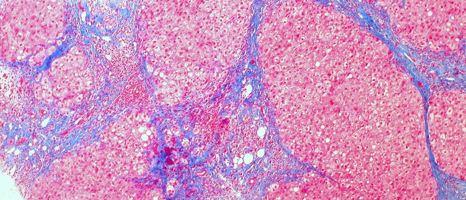 Micrograph of a liver biopsy stained with trichrome, showing pink nodules of liver cells separated by blue bands of scar tissue, the pattern of cirrhosis.