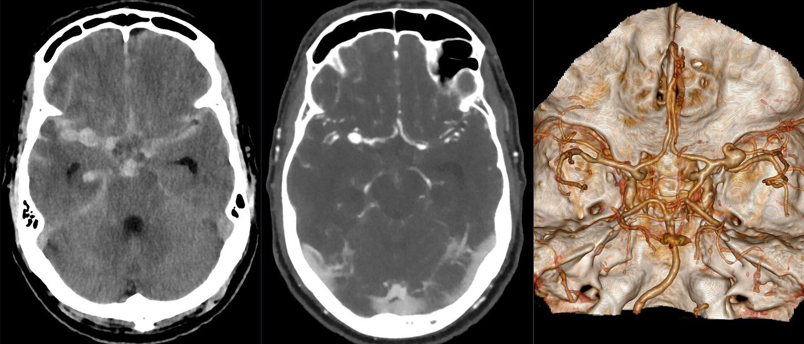 Brain CT, CT angiogram and a 3D reconstruction of the brain's arteries showing a bleeding aneurysm, side by side on a black background.