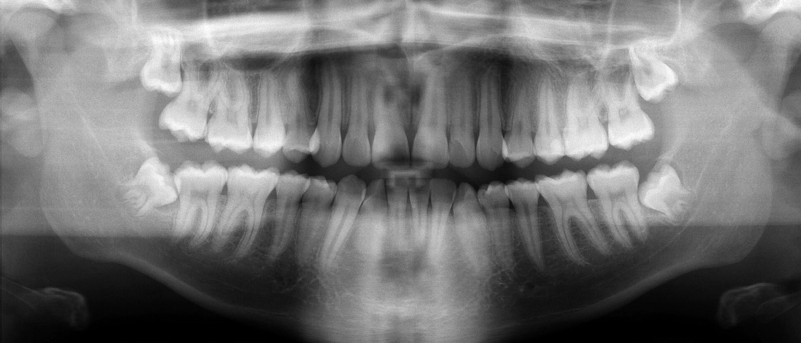 Panoramic X-ray of both jaws showing a full set of teeth, with impacted wisdom teeth at the back of the upper and lower jaws.
