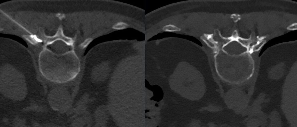 CT scans of the thoracic spine showing a needle placed into the small joints beside a vertebra for a pain-relieving injection.