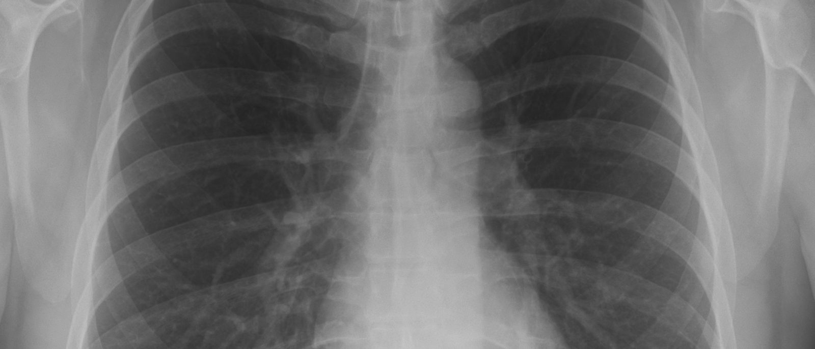 Normal chest X-ray taken from the front, showing both lungs, the ribs and the heart in the centre.