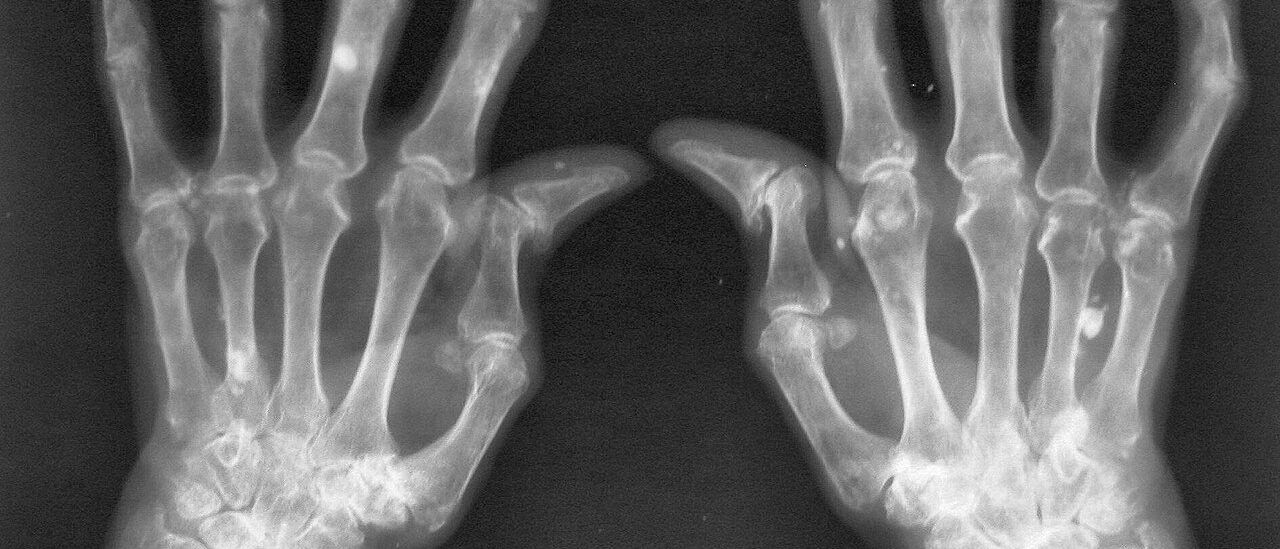 Radiograph of both hands affected by rheumatoid arthritis, with eroded and narrowed wrist and finger joints.
