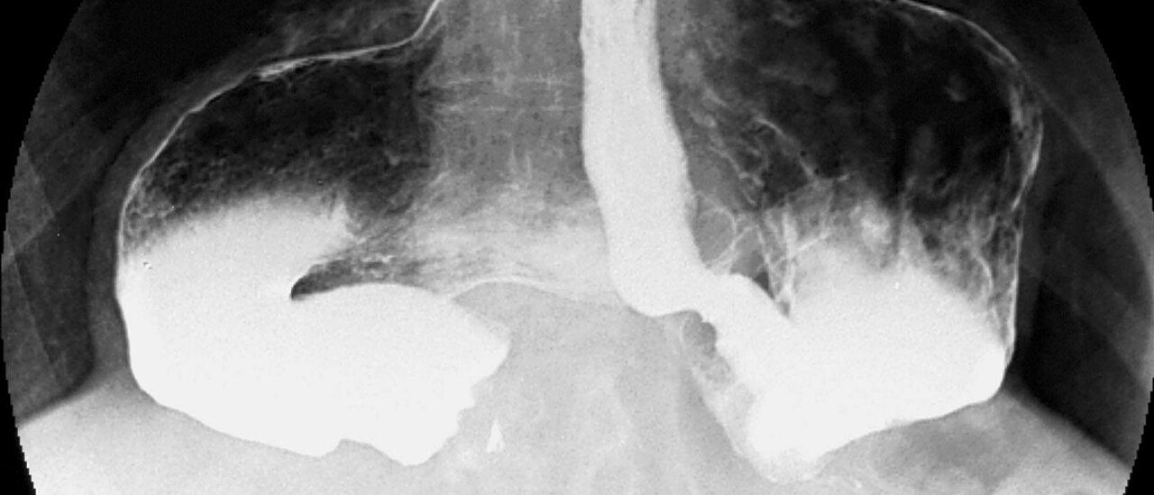 Barium contrast X-ray showing the oesophagus and a contrast-filled stomach that has moved up into the chest.