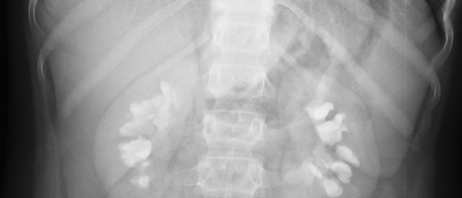 Abdominal X-ray taken after a contrast injection, with the drainage systems of both kidneys showing bright white on either side of the spine.
