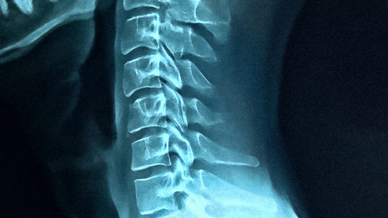 Lateral cervical spine X-ray
